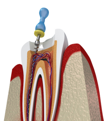 Root canal treatment