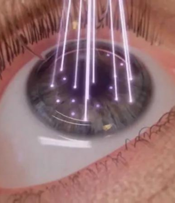 Lasik Laser