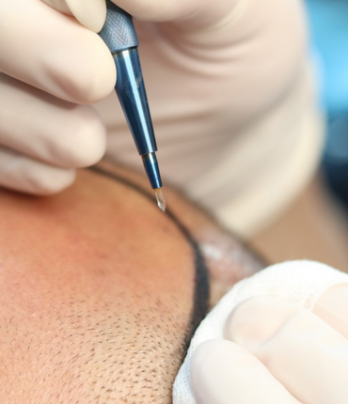 Hair transplant with sapphire technique