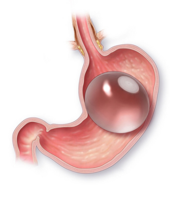 Gastric Balloon