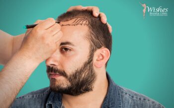 Instructions Before And After Hair Transplantation Operation